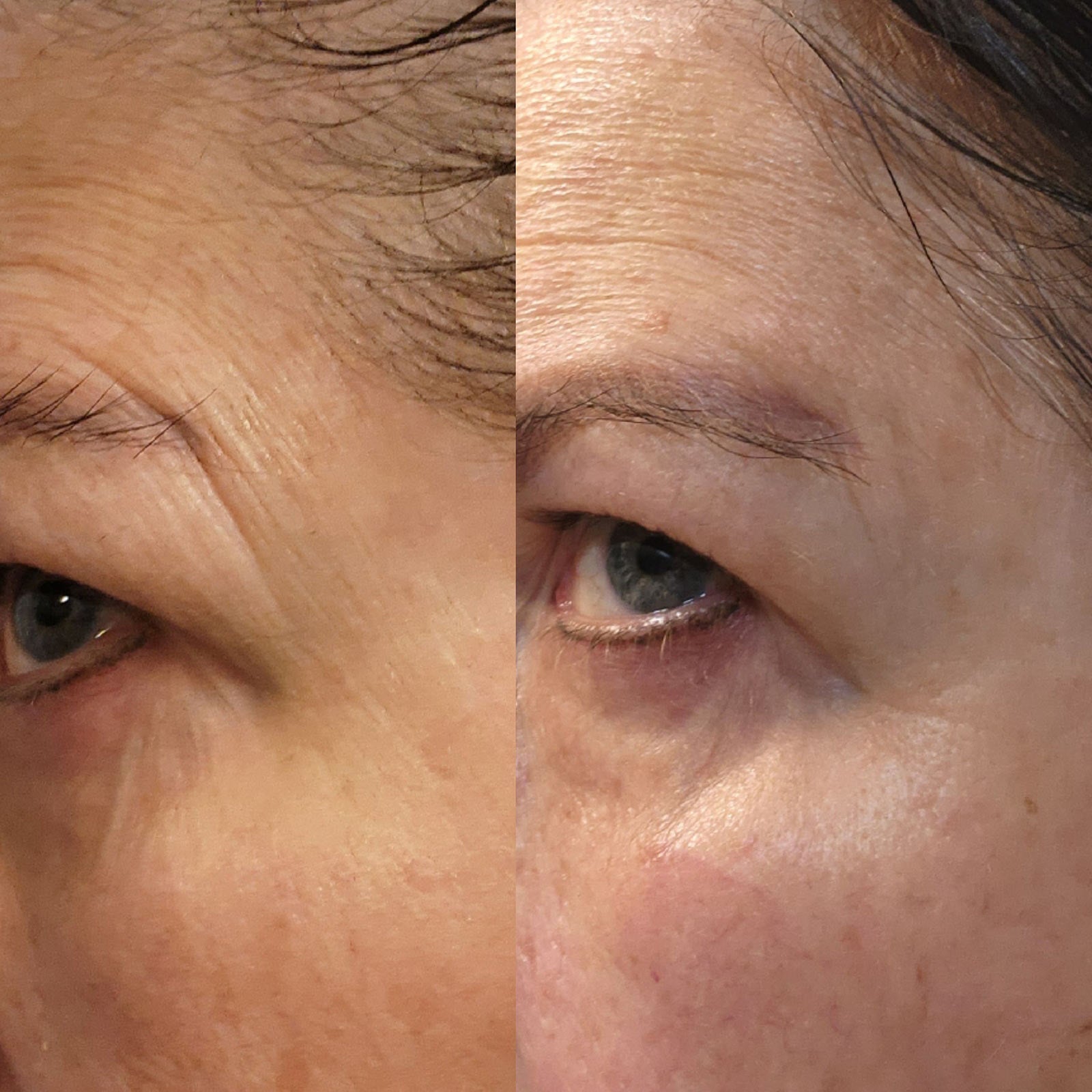 Before and After Comparison Using Skin Authority Wrinkle Reversing Serum