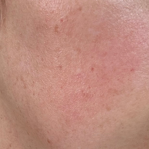 Skin texture after application with visible redness