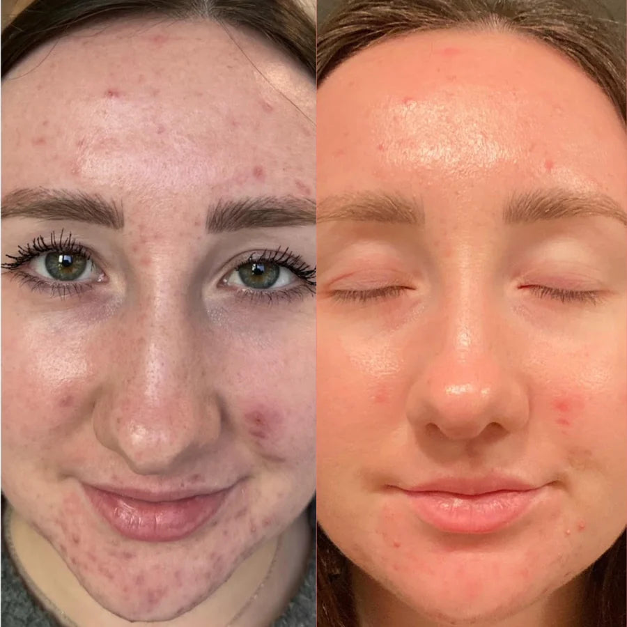 Clarifying liquid peel